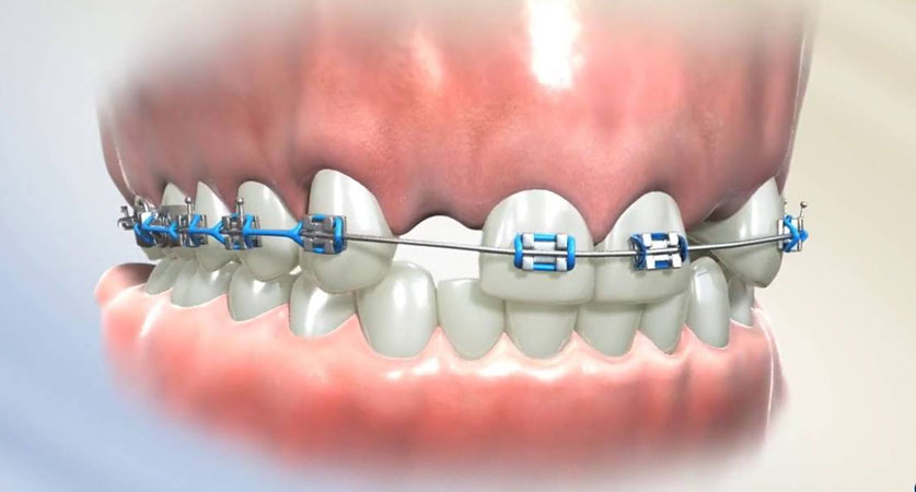 braces with missing teeth