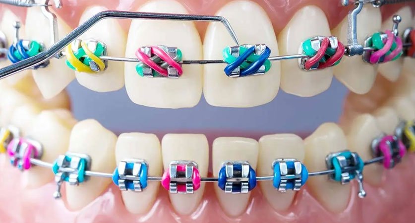 color braces