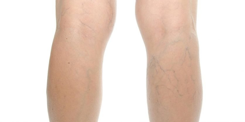 Varicose Veins