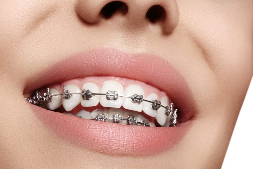 Braces