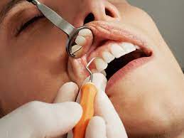 Deep Cleaning Dental Procedure