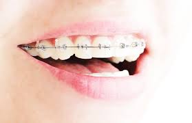 braces before implants