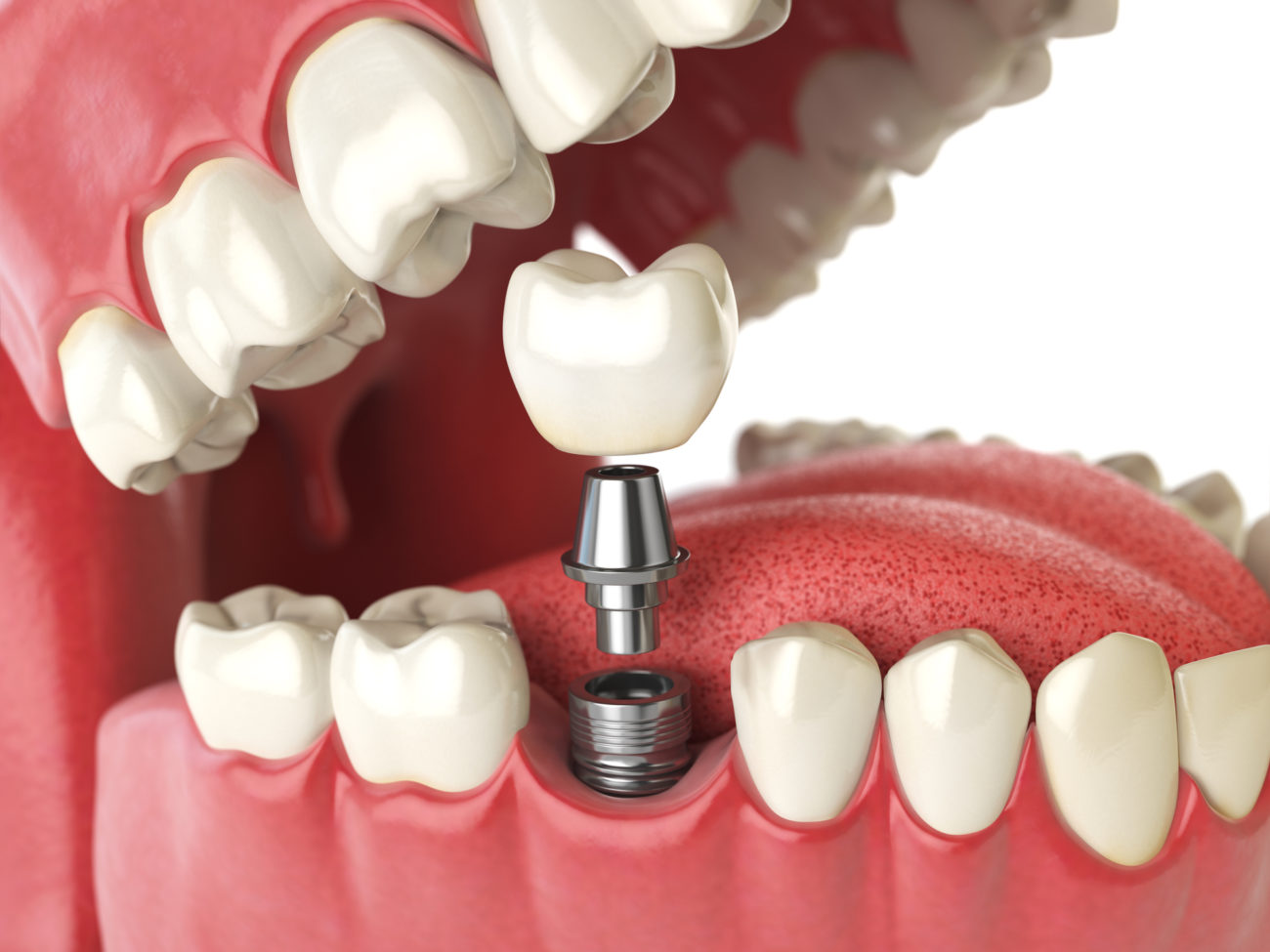 tooth implant Houston.