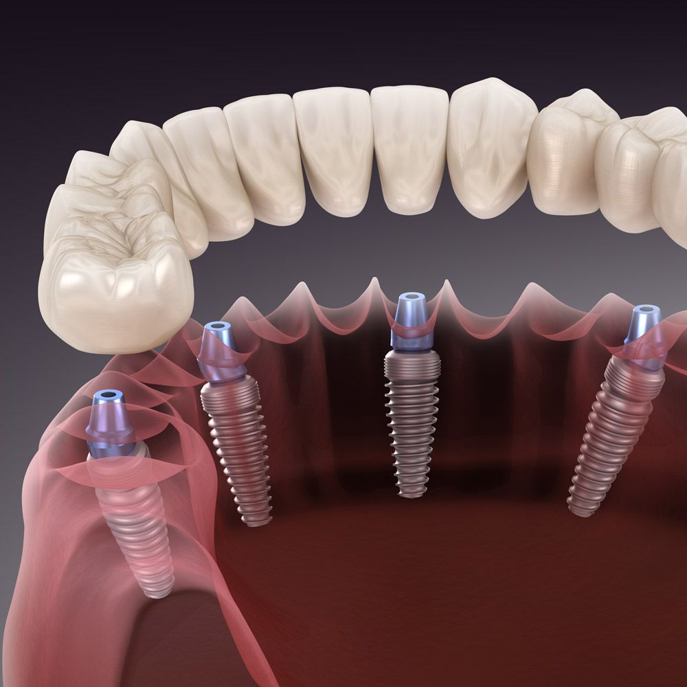 Dental Implants Houston Midtown