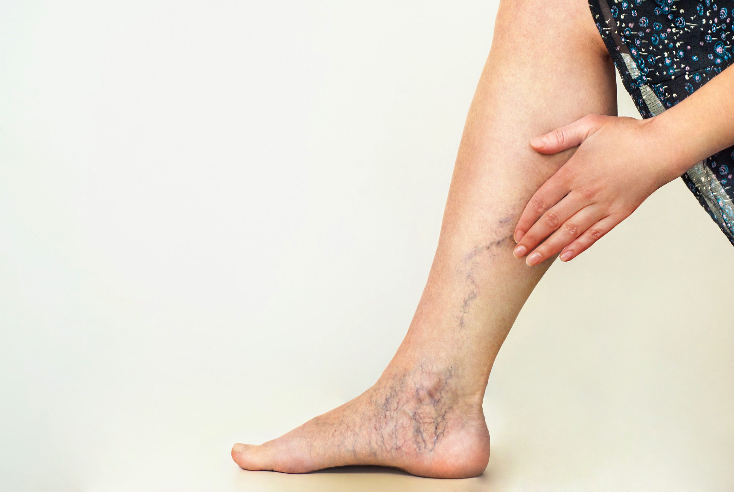 What is the latest treatment for varicose veins
