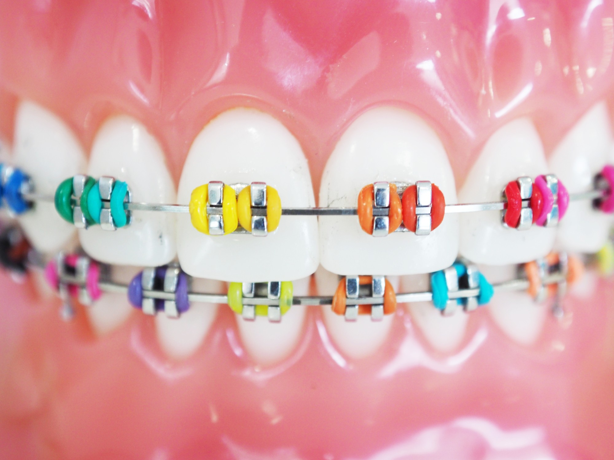 braces colors that make your teeth look whiter