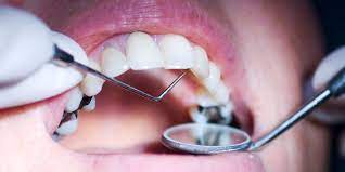 cavity removal