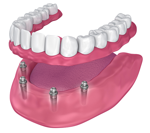 Dental implants in houston tx