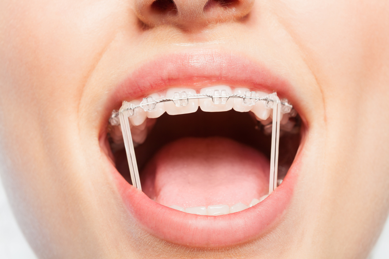 braces with rubber bands