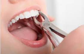 wisdom teeth removal dentist