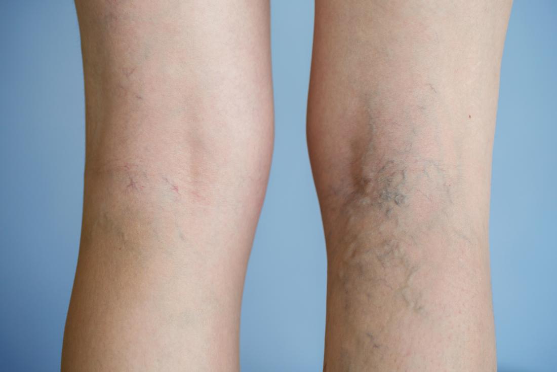 what is a varicose vein specialist called