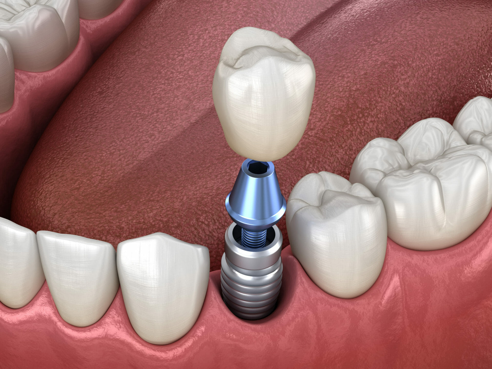 houston dental implant