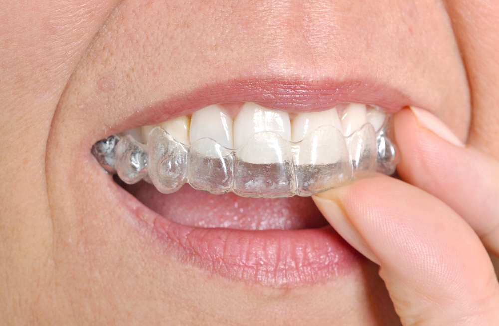 alternatives to braces